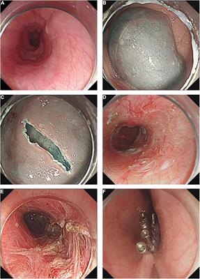 Peroral Endoscopic Myotomy for Pediatric Achalasia: A Retrospective Analysis of 21 Cases With a Minimum Follow-Up of 5 Years